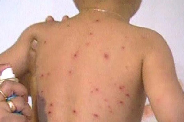 Épidémie de rougeole : 26 cas enregistrés à Vélingara