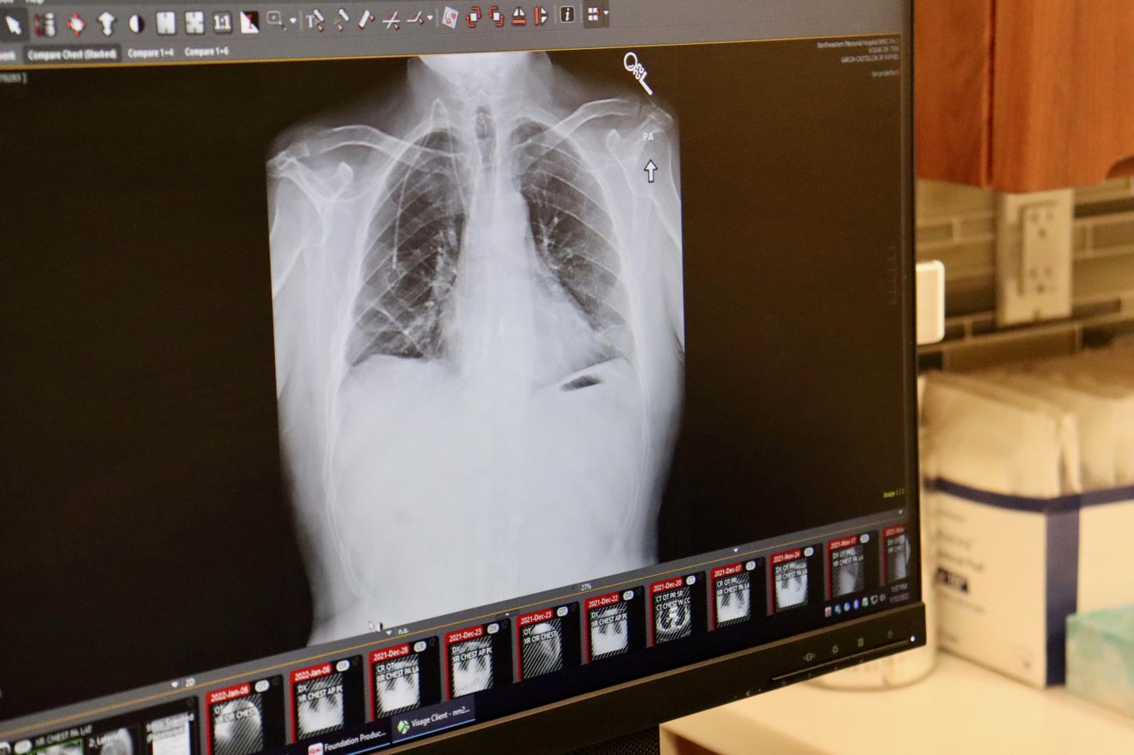 Un homme atteint d\'un cancer terminal des poumons sauvé aux Etats-Unis par une double greffe