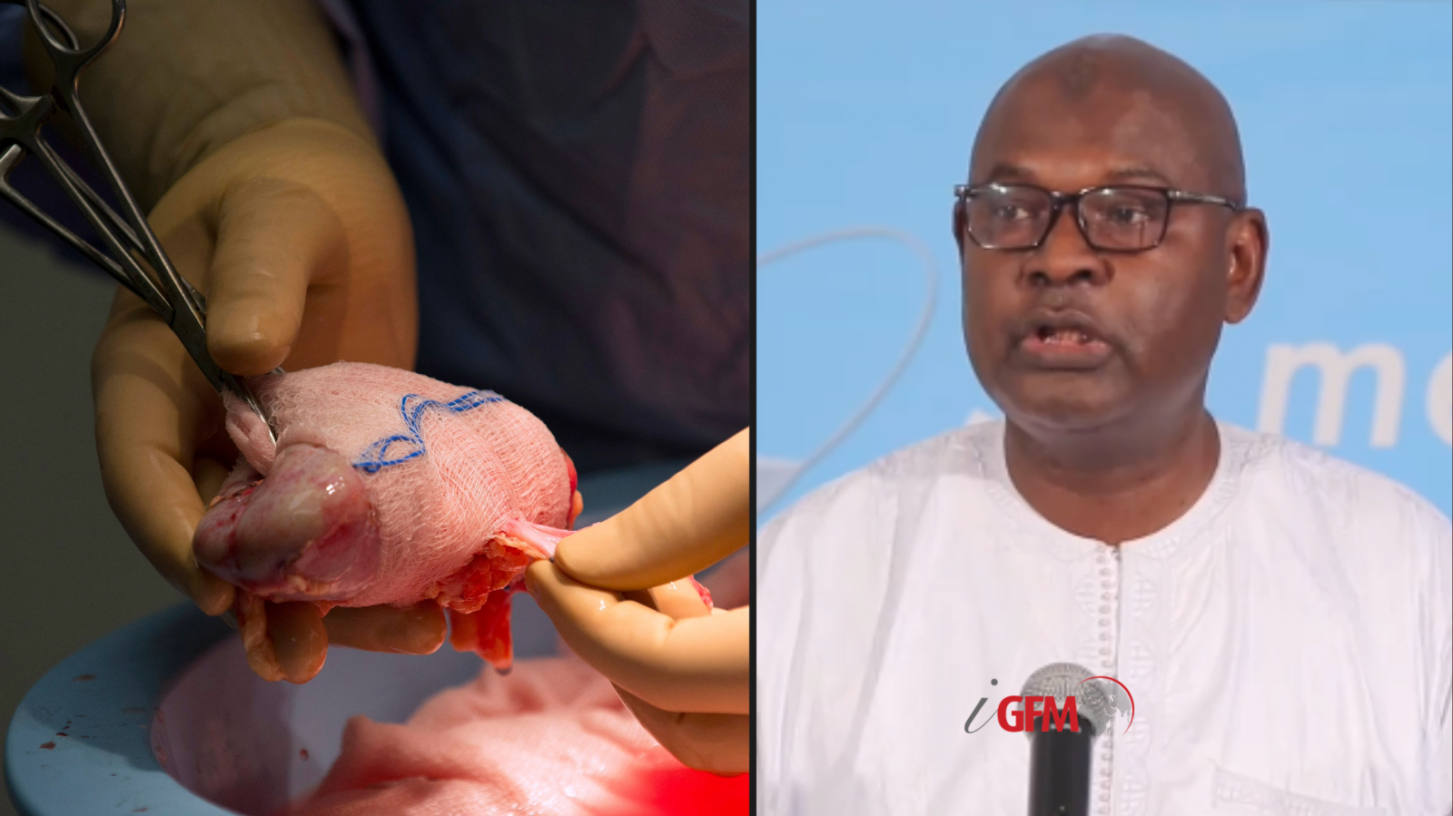 Transplantation rénale au Sénégal : Le dispositif pour éviter tout trafic d’organes !